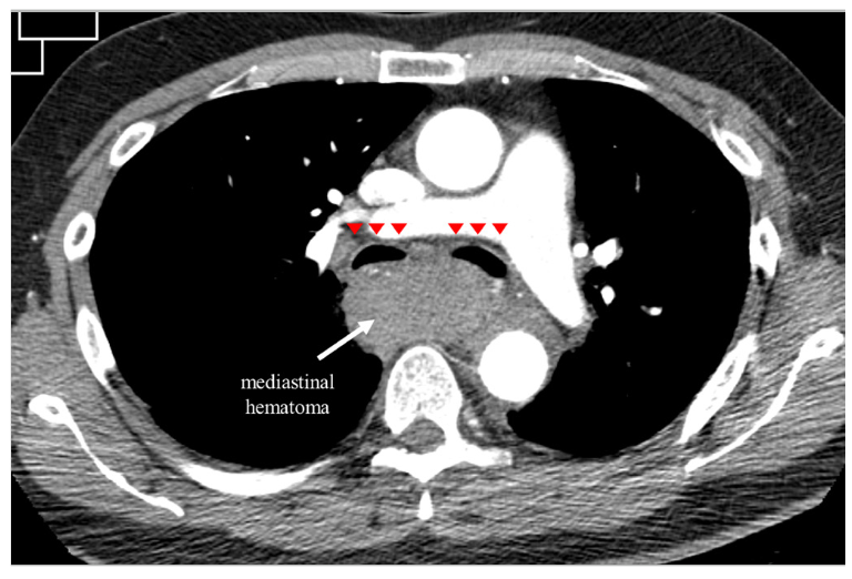 Coil Embolization for Complications Following PCI JIC